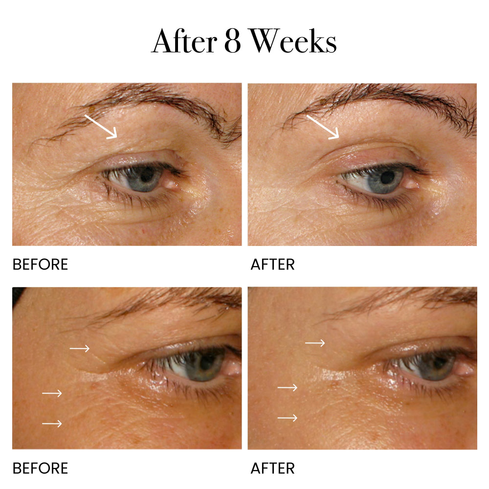 Before and after clinical photos showing reduction in fine lines and wrinkles around the eyes after 8 weeks using Super Beauty Elixir.